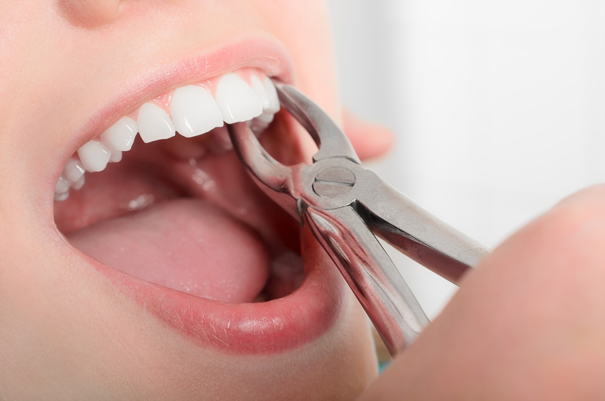 teeth extractions