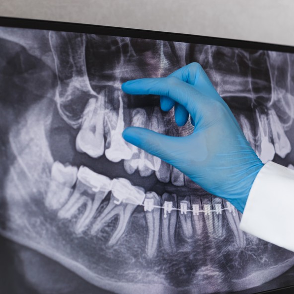 What You Should Know About Root Canals