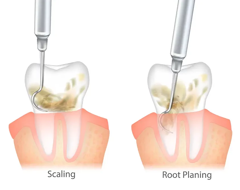 Scaling and Root Planing