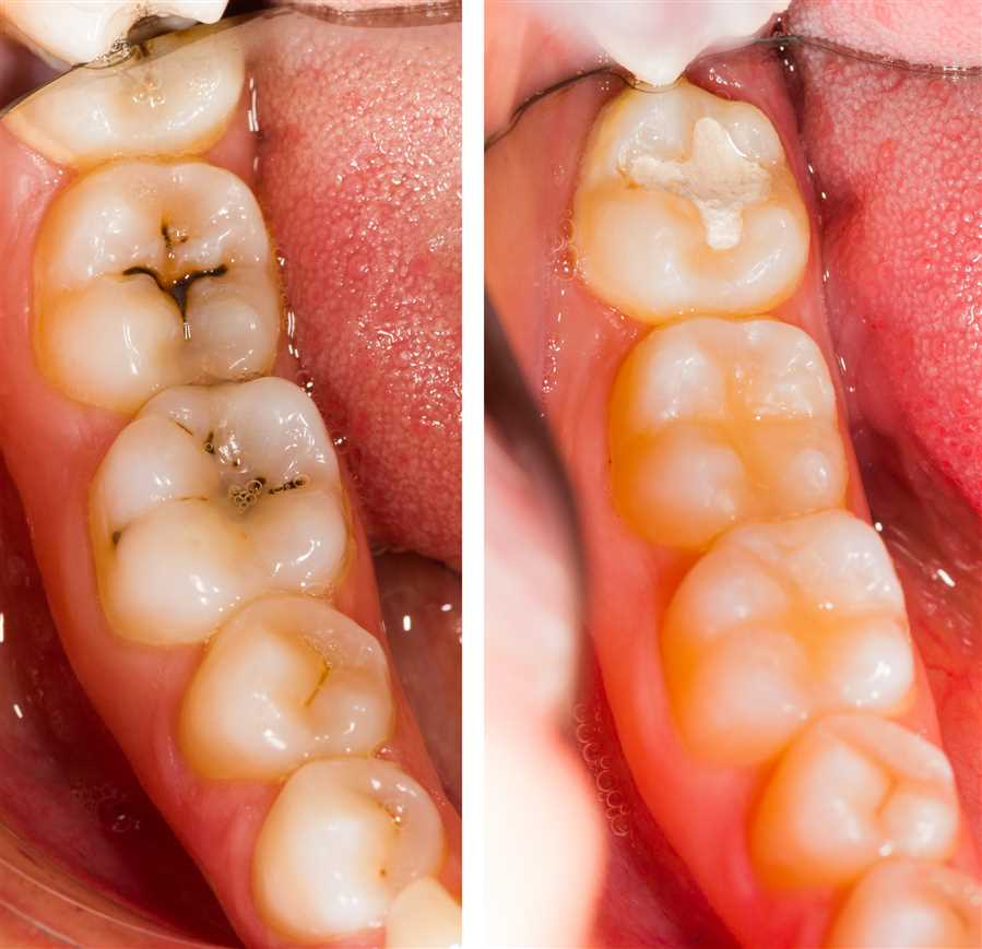 White fillings-Before and after
