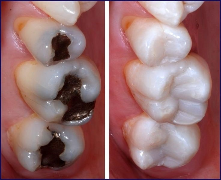 White fillings effectively restore the natural appearance of your teeth
