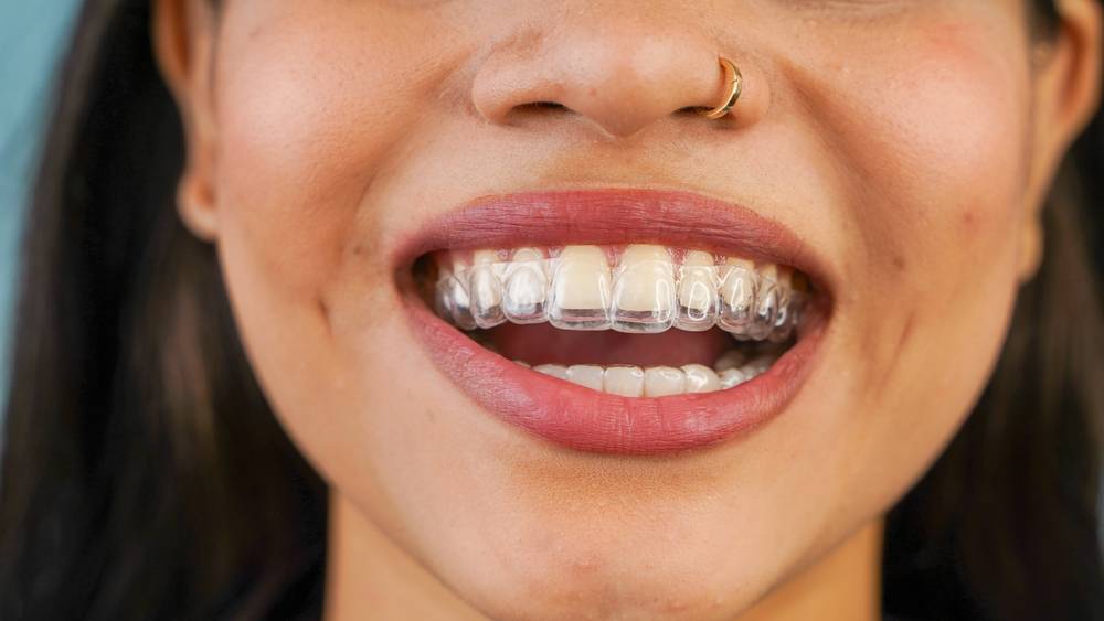 Will Clear Braces Turn Yellow? How to Keep Them Looking Fresh?